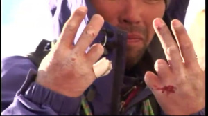 登山家・山野井泰史さんは凍傷で指を切断